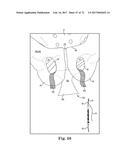 TISSUE ANCHOR AND A SUTURE INSERTED THROUGH THE TISSUE ANCHOR HAVING END     PORTIONS OF THE SUTURE MAINTAINED WITHIN A CONDUIT diagram and image