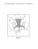 TISSUE ANCHOR AND A SUTURE INSERTED THROUGH THE TISSUE ANCHOR HAVING END     PORTIONS OF THE SUTURE MAINTAINED WITHIN A CONDUIT diagram and image