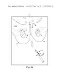 TISSUE ANCHOR AND A SUTURE INSERTED THROUGH THE TISSUE ANCHOR HAVING END     PORTIONS OF THE SUTURE MAINTAINED WITHIN A CONDUIT diagram and image