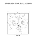 TISSUE ANCHOR AND A SUTURE INSERTED THROUGH THE TISSUE ANCHOR HAVING END     PORTIONS OF THE SUTURE MAINTAINED WITHIN A CONDUIT diagram and image