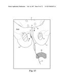 TISSUE ANCHOR AND A SUTURE INSERTED THROUGH THE TISSUE ANCHOR HAVING END     PORTIONS OF THE SUTURE MAINTAINED WITHIN A CONDUIT diagram and image