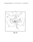 TISSUE ANCHOR AND A SUTURE INSERTED THROUGH THE TISSUE ANCHOR HAVING END     PORTIONS OF THE SUTURE MAINTAINED WITHIN A CONDUIT diagram and image