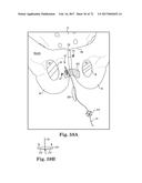 TISSUE ANCHOR AND A SUTURE INSERTED THROUGH THE TISSUE ANCHOR HAVING END     PORTIONS OF THE SUTURE MAINTAINED WITHIN A CONDUIT diagram and image