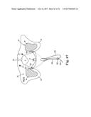 TISSUE ANCHOR AND A SUTURE INSERTED THROUGH THE TISSUE ANCHOR HAVING END     PORTIONS OF THE SUTURE MAINTAINED WITHIN A CONDUIT diagram and image