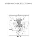 TISSUE ANCHOR AND A SUTURE INSERTED THROUGH THE TISSUE ANCHOR HAVING END     PORTIONS OF THE SUTURE MAINTAINED WITHIN A CONDUIT diagram and image