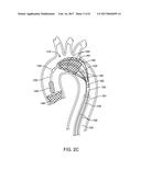 INTEGRATED EMBOLIC PROTECTION DEVICES diagram and image