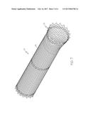 STENT HAVING REMOVABLE ANCHORING ELEMENT diagram and image