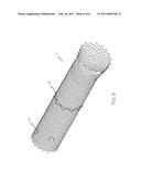 STENT HAVING REMOVABLE ANCHORING ELEMENT diagram and image