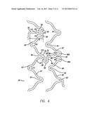 INTRAVASCULAR STENT diagram and image