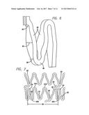 INTRAVASCULAR STENT diagram and image