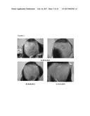 A PHARMACEUTICAL COMPOSITION COMPRISING A SUSPENSION OF TOTAL CELLS     OBTAINED FROM HAIR FOLLICLE AND PLASMA DERIVED GROWTH FACTORS FOR     PROMOTING HAIR FOLLICLE REGENERATION diagram and image