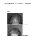 A PHARMACEUTICAL COMPOSITION COMPRISING A SUSPENSION OF TOTAL CELLS     OBTAINED FROM HAIR FOLLICLE AND PLASMA DERIVED GROWTH FACTORS FOR     PROMOTING HAIR FOLLICLE REGENERATION diagram and image