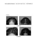 A PHARMACEUTICAL COMPOSITION COMPRISING A SUSPENSION OF TOTAL CELLS     OBTAINED FROM HAIR FOLLICLE AND PLASMA DERIVED GROWTH FACTORS FOR     PROMOTING HAIR FOLLICLE REGENERATION diagram and image