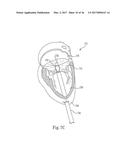 MITRAL PROSTHESIS AND METHODS FOR IMPLANTATION diagram and image