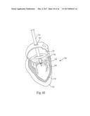 MITRAL PROSTHESIS AND METHODS FOR IMPLANTATION diagram and image