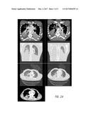 USE OF LEVOCETIRIZINE AND MONTELUKAST IN THE TREATMENT OF TRAUMATIC INJURY diagram and image