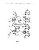 Bone Fixation Apparatus diagram and image