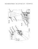 DENTAL IMPLANT FOR BONE COLLECTION AND DISTRIBUTION diagram and image