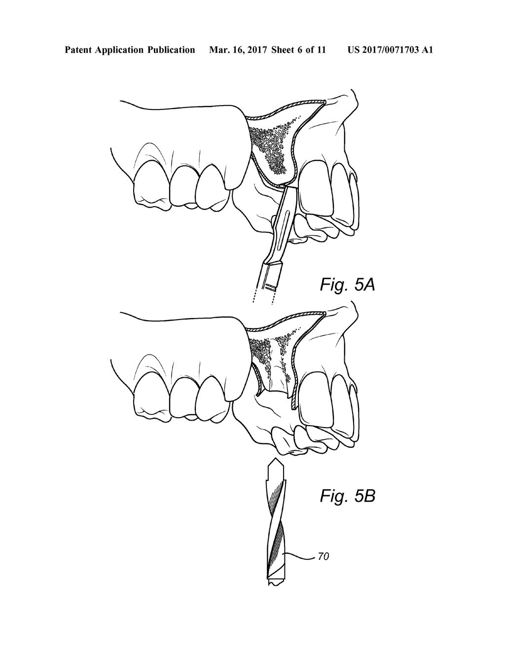 DENTAL IMPLANT - diagram, schematic, and image 07