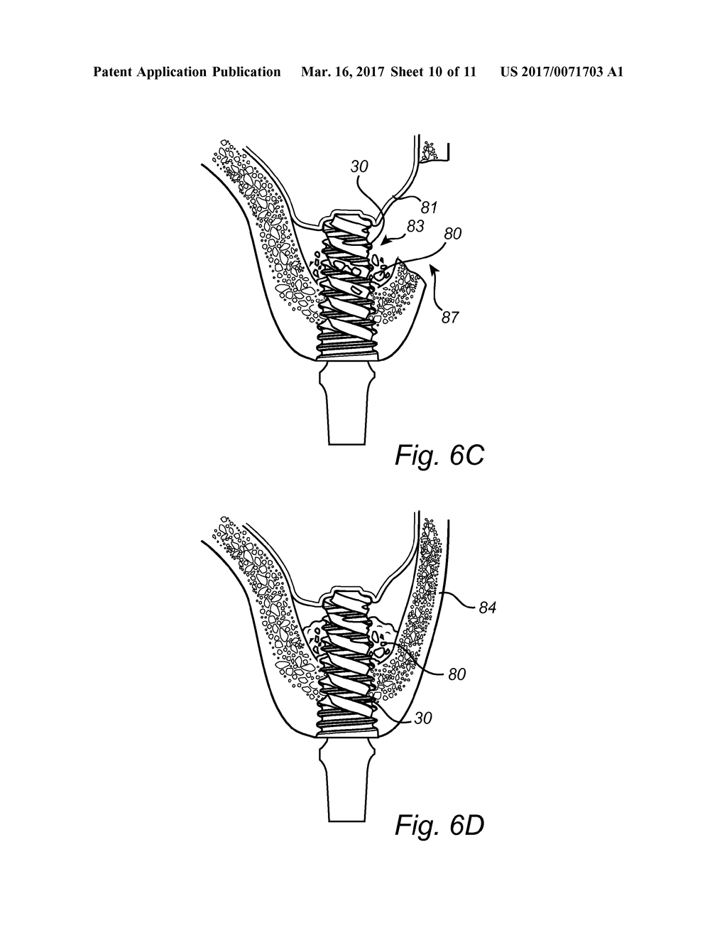 DENTAL IMPLANT - diagram, schematic, and image 11