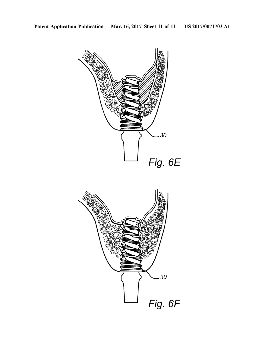 DENTAL IMPLANT - diagram, schematic, and image 12