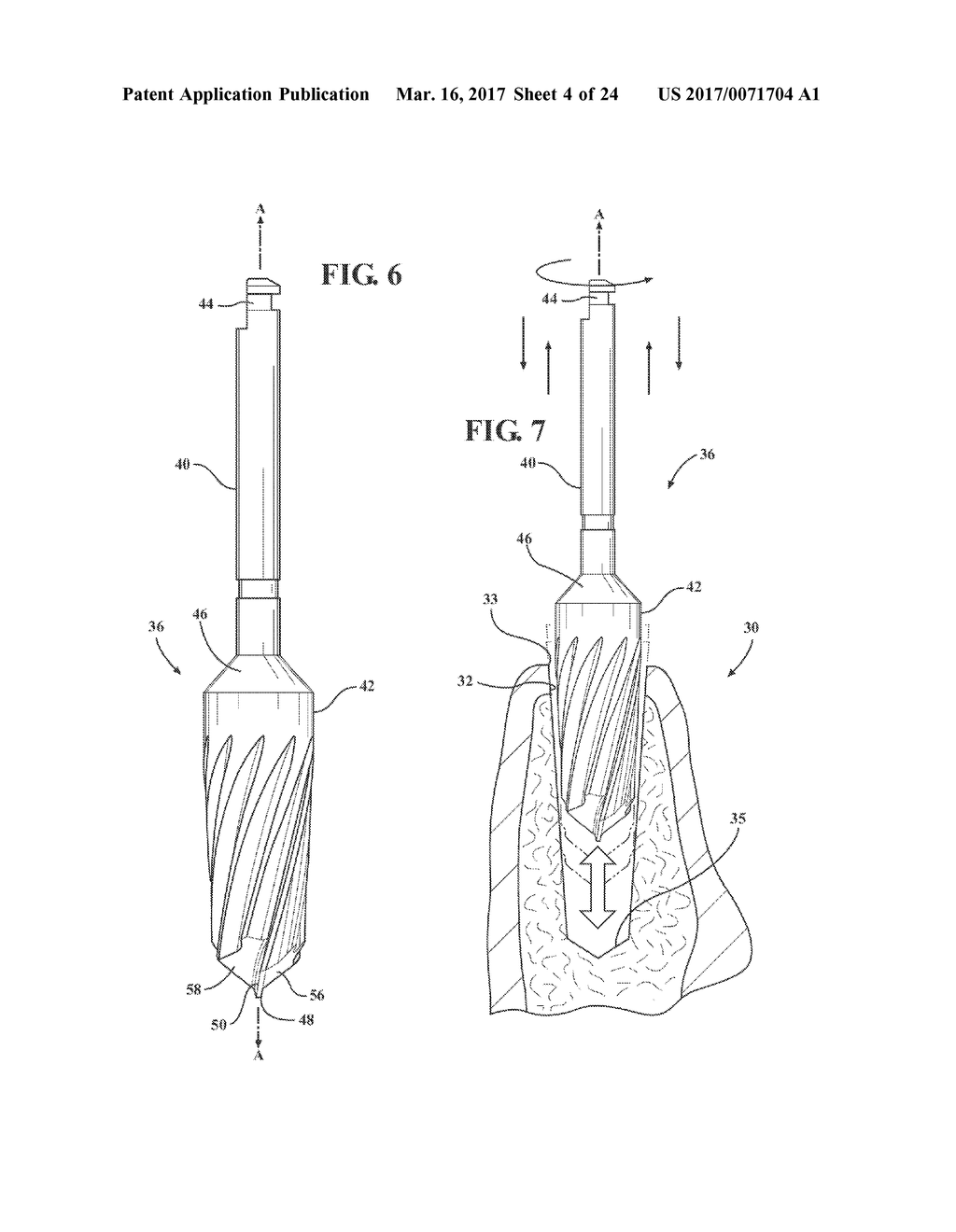 HYDRO-MECHANICAL AUTOGRAFTING TOOL AND METHOD OF USE - diagram, schematic, and image 05