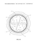 HYDRO-MECHANICAL AUTOGRAFTING TOOL AND METHOD OF USE diagram and image