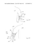 APPARATUS AND METHOD FOR CONTROLLING VISIBILITY AND ACCESS TO CENTRAL     VENOUS ACCESS DEVICES diagram and image