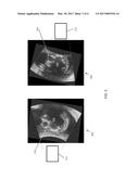 ACQUISITION-ORIENTATION-DEPENDENT FEATURES FOR MODEL-BASED SEGMENTATION OF     ULTRASOUND IMAGES diagram and image