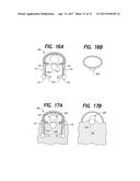 VEIN DISSECTING DEVICE AND METHOD diagram and image