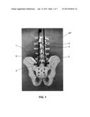 ILIAC CONNECTOR, CONNECTOR HEAD, SPINAL FIXATION SYSTEM AND METHOD OF     STABILIZING A SPINE diagram and image