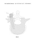 ORTHOPEDIC FIXATION DEVICES AND METHODS OF INSTALLATION THEREOF diagram and image