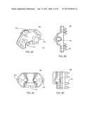 Interspinous Process Spacing Device diagram and image