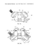 Interspinous Process Spacing Device diagram and image