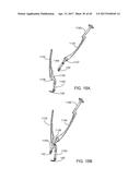 Interspinous Process Spacing Device diagram and image