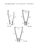 Interspinous Process Spacing Device diagram and image