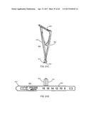 Interspinous Process Spacing Device diagram and image