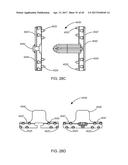 Interspinous Process Spacing Device diagram and image