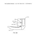 Interspinous Process Spacing Device diagram and image