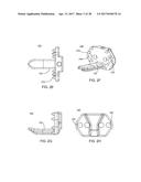 Interspinous Process Spacing Device diagram and image