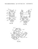 Interspinous Process Spacing Device diagram and image