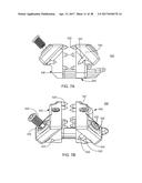 Interspinous Process Spacing Device diagram and image