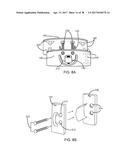 Interspinous Process Spacing Device diagram and image