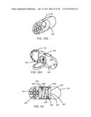 Interspinous Process Spacing Device diagram and image