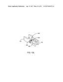 Interspinous Process Spacing Device diagram and image