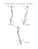 Interspinous Process Spacing Device diagram and image