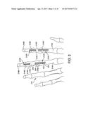 FUSION IMPLANT diagram and image