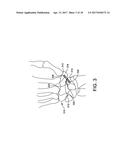 FUSION IMPLANT diagram and image