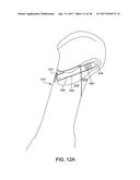 FUSION IMPLANT diagram and image