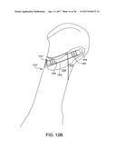 FUSION IMPLANT diagram and image